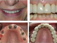 RIABILITAZIONE CON PONTE CIRCOLARE IN PORCELLANA SU IMPIANTI
