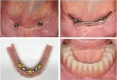 PROTESI TOTALE INFERIORE ANCORATA A STRUTTURA IMPLANTARE